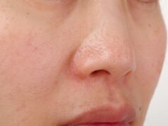 Embarrassed by Bumpy Skin? Solutions for Strawberry/Chicken Skin Bumpy Skin