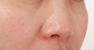 Embarrassed by Bumpy Skin? Solutions for Strawberry/Chicken Skin Bumpy Skin