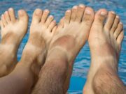 Easy Home Remedies to Remove Sun Tan from Feet Remove Sun Tan from Feet